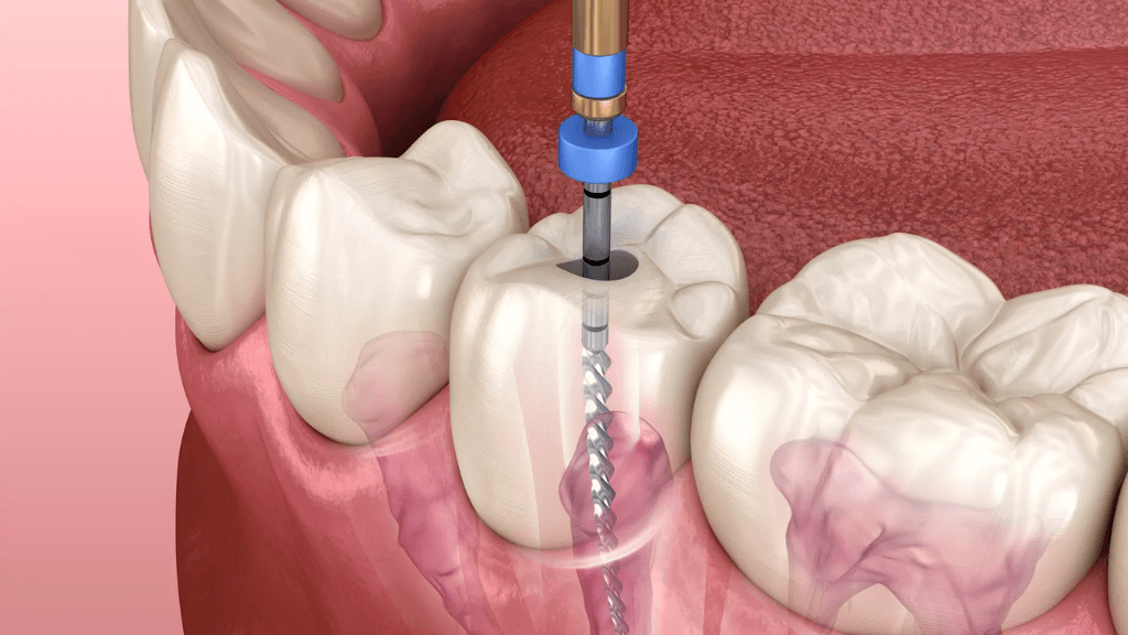 What is Anterior Root Canal Treatment?