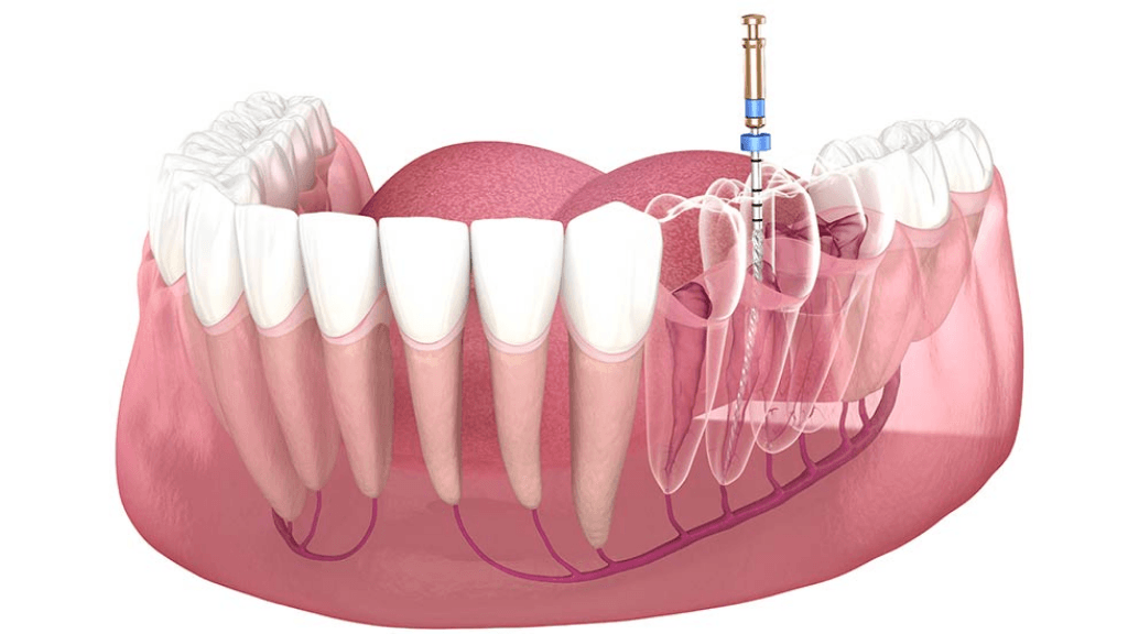 What is Posterior Root Canal Treatment (RCT)?