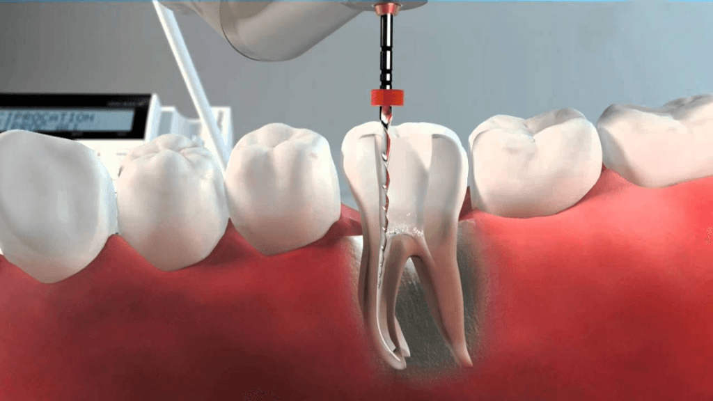What is Re-Root Canal Treatment (RE-RCT)?