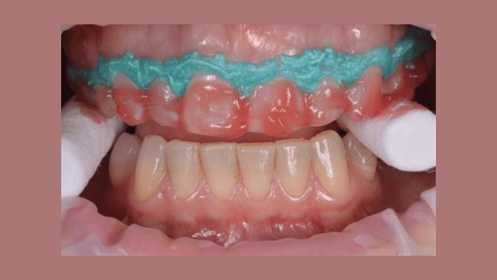 Benefits of Teeth Whitening