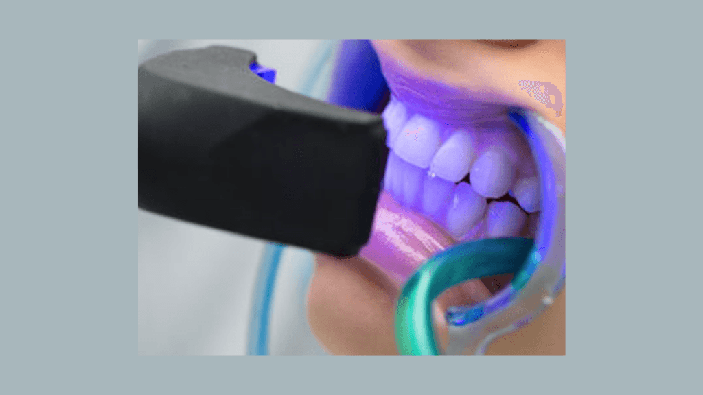 What is Bleaching with Laser?