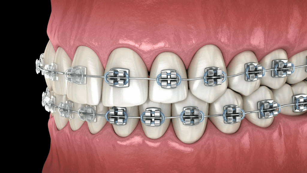 What are Self-Ligating Ceramic Braces?
