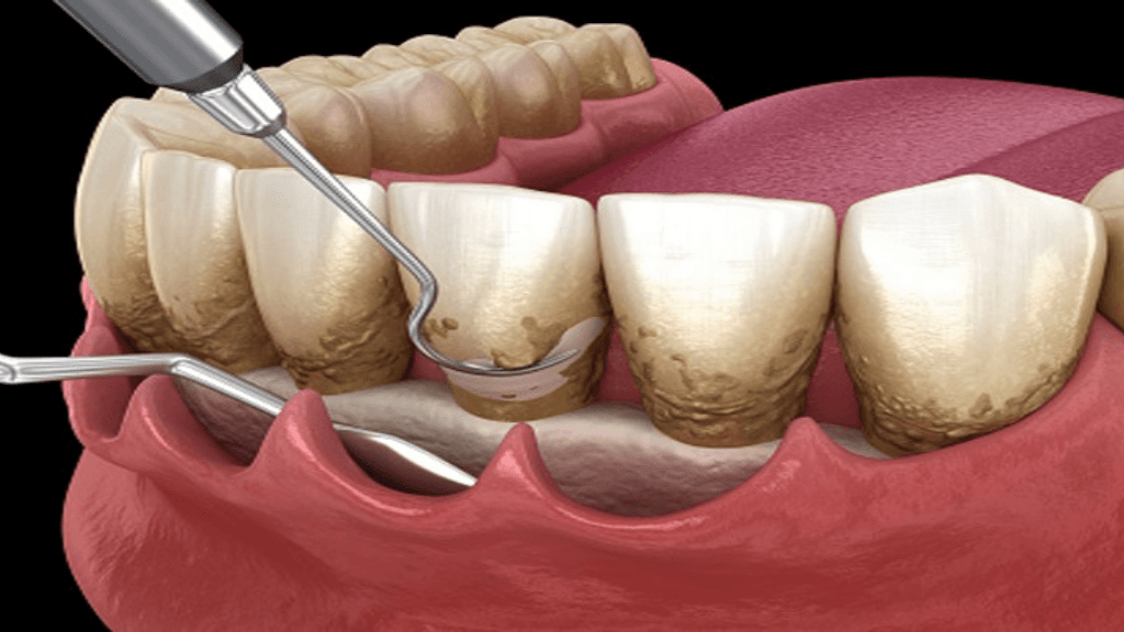 What is Full Mouth Curettage?