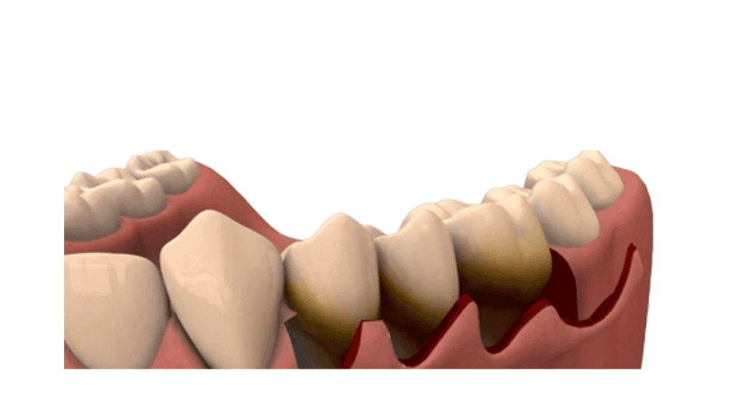 What is Full Mouth Flap Surgery?