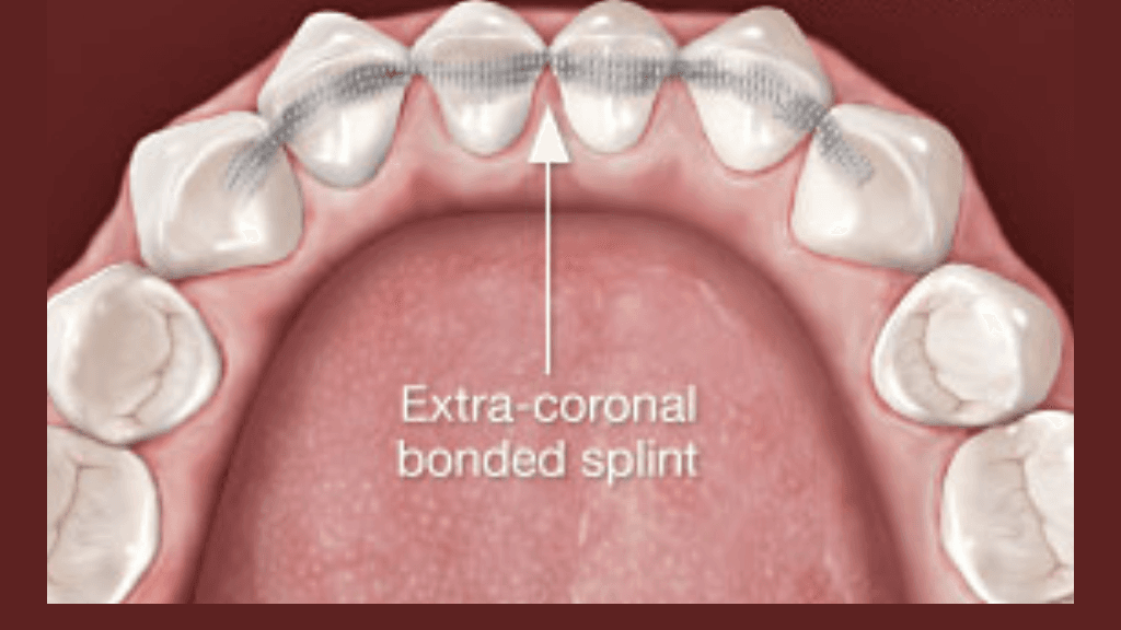 Applications of Splinting