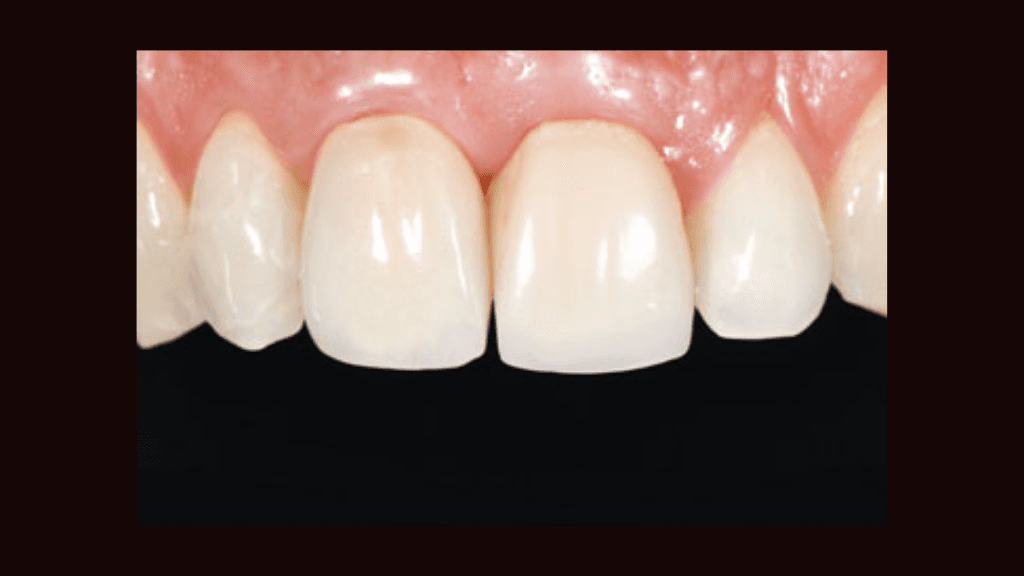 What are Acrylic Crowns?