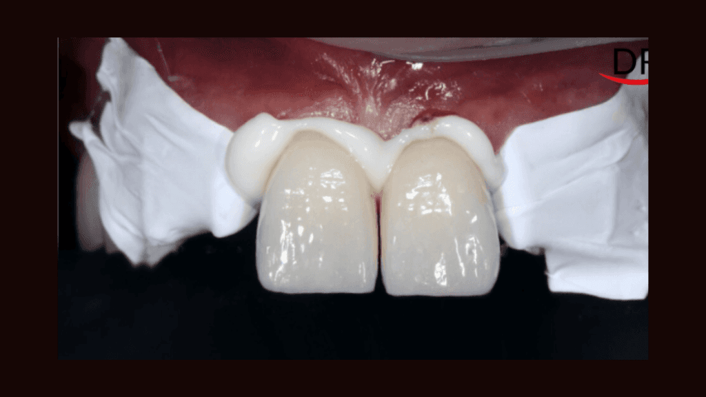 What is Crown Recementation?