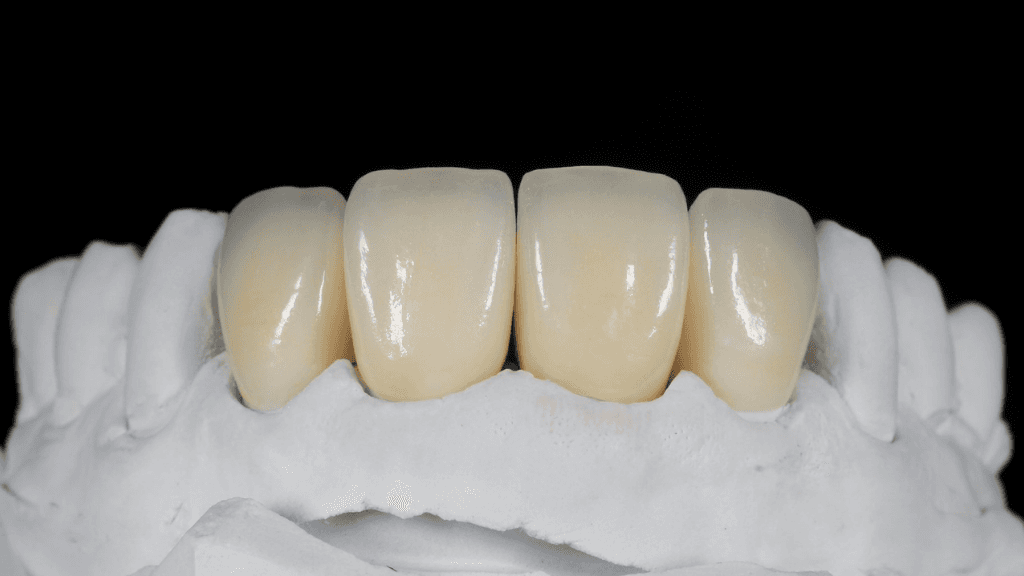 What are Zirconia Crowns?