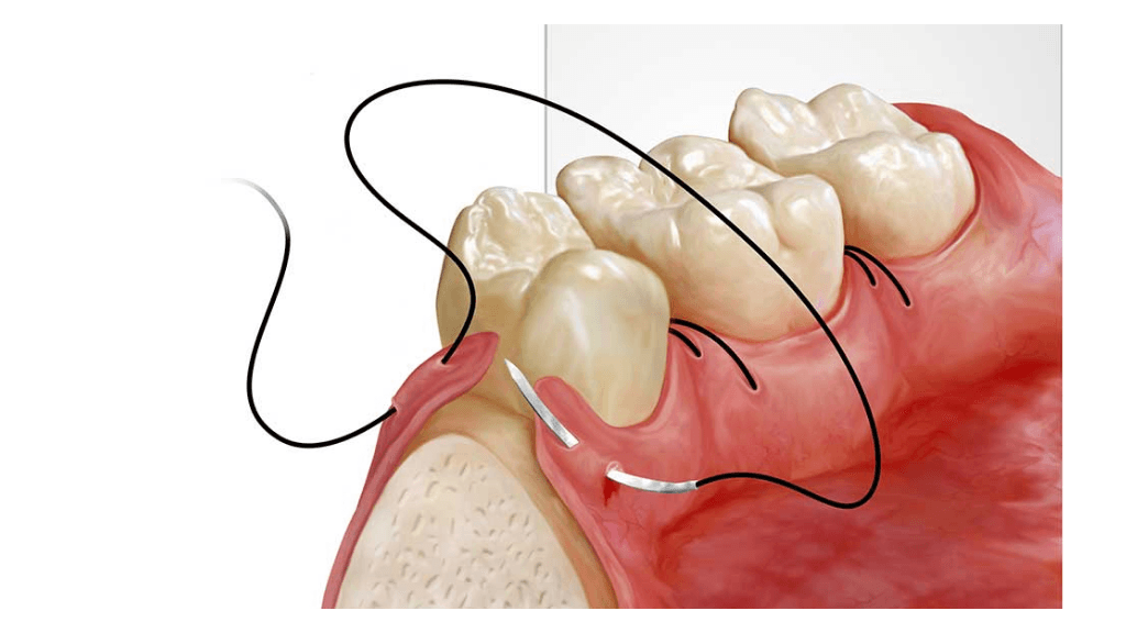 Smoothing the Foundation