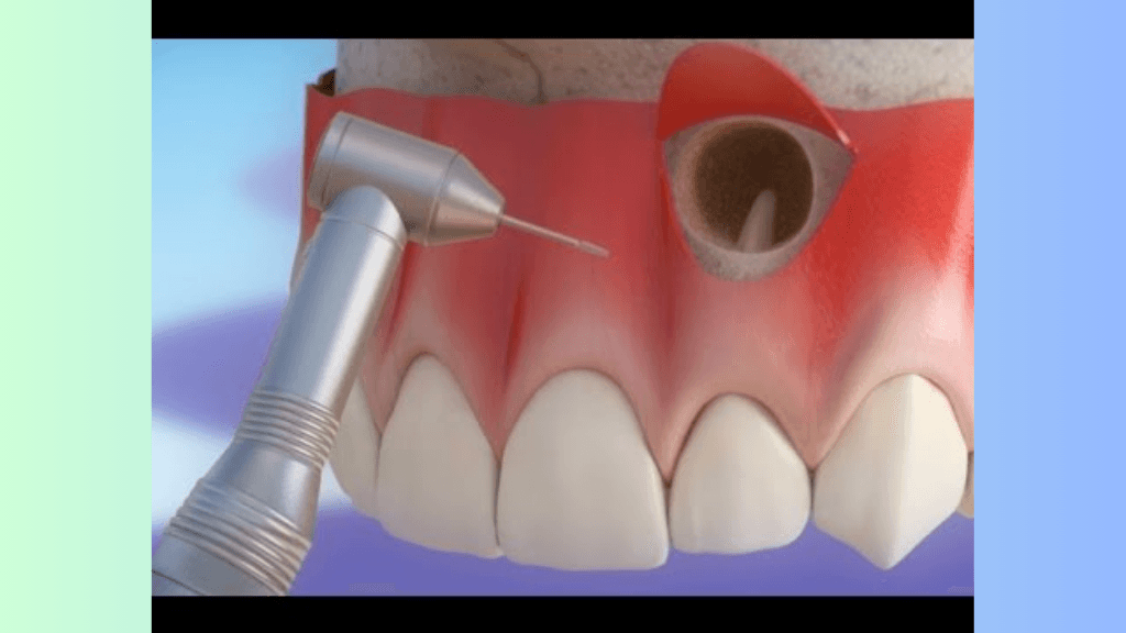 Precision Root Surgery