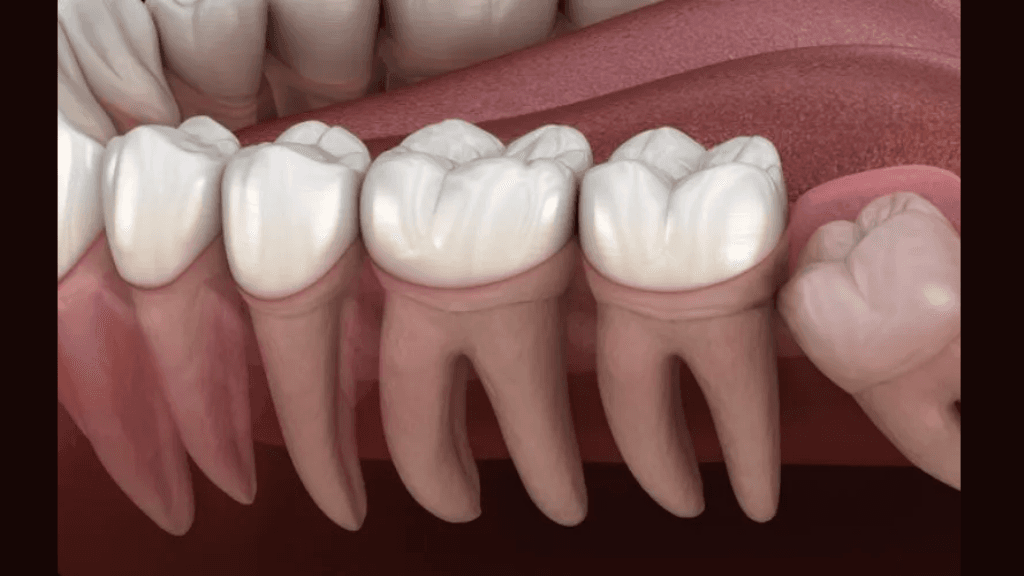 Comprehensive Impaction Services