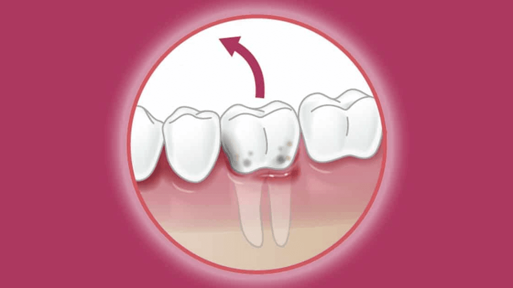What is Simple Tooth Extraction?