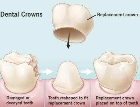 Crowns & Veneers